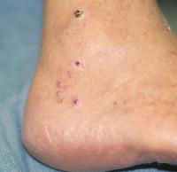 sarcoma